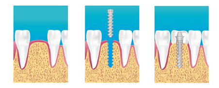 Implants dentaires à Annecy